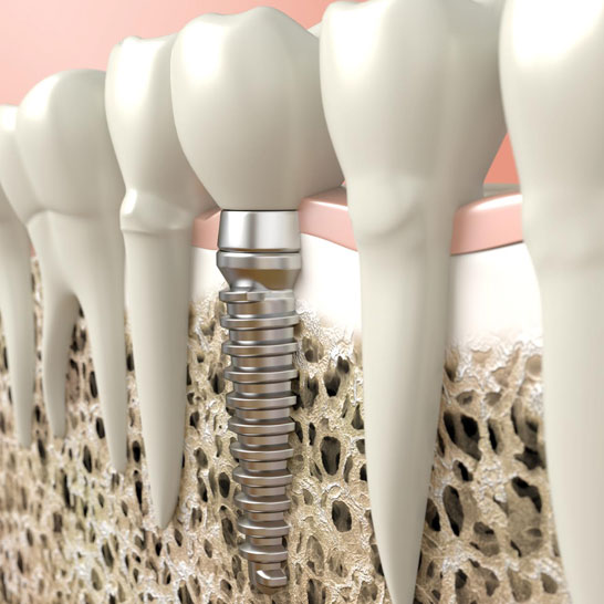 Fixed and Removable prosthodontics