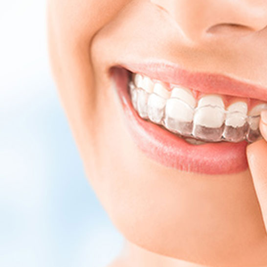 Invisalign